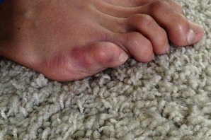Kyle's toe